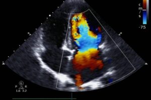 GE’s Pocket-sized Echocardiogram Device | Smart Telecardiology